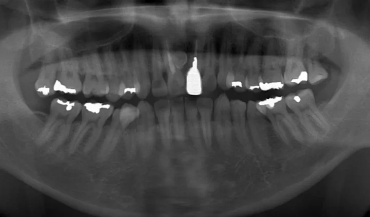 日本歯科グループの症例写真・治療前