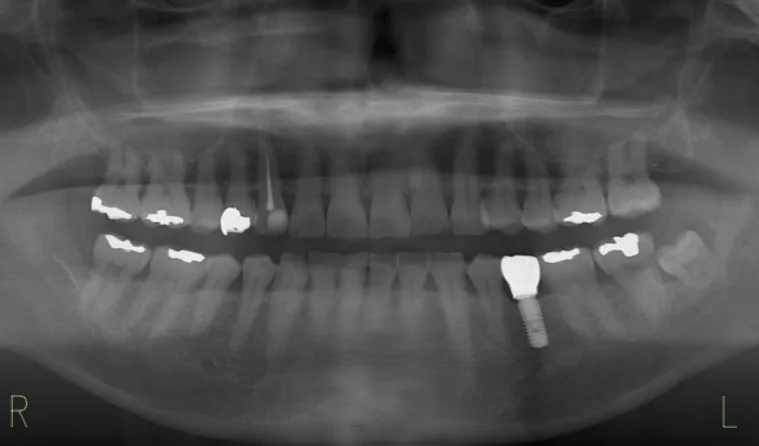 日本歯科グループの症例写真・治療後